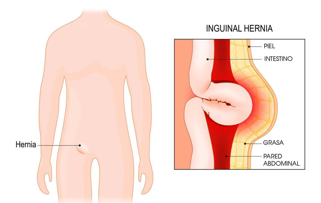 Hernia Inguinal