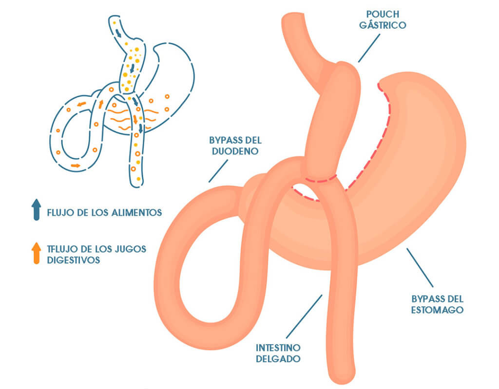 Mini bypass gástrico