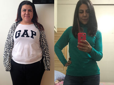 Mujer antes y después de Cirugía Bariátrica