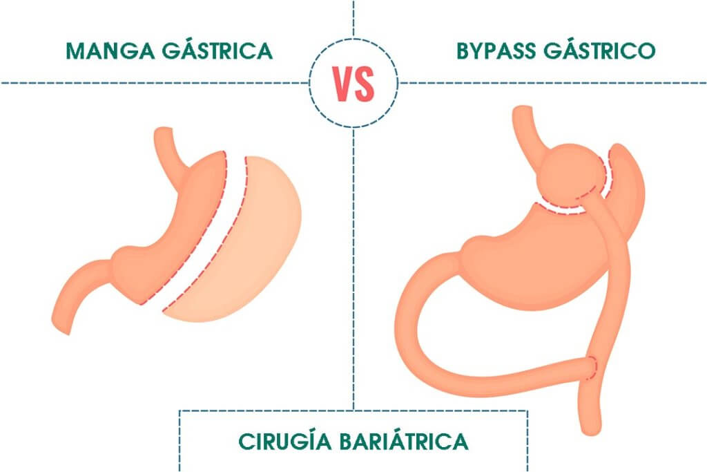 diferencia entre manga gastrica y bypass