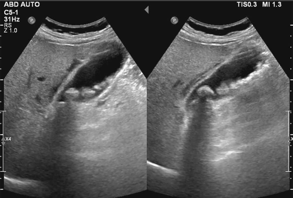 ultrasonido de la vesícula biliar